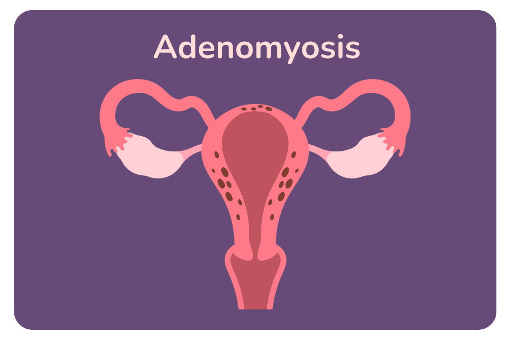 Adenomyosis symptoms.