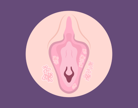 vaginal health, vaginal pimples, genital warts