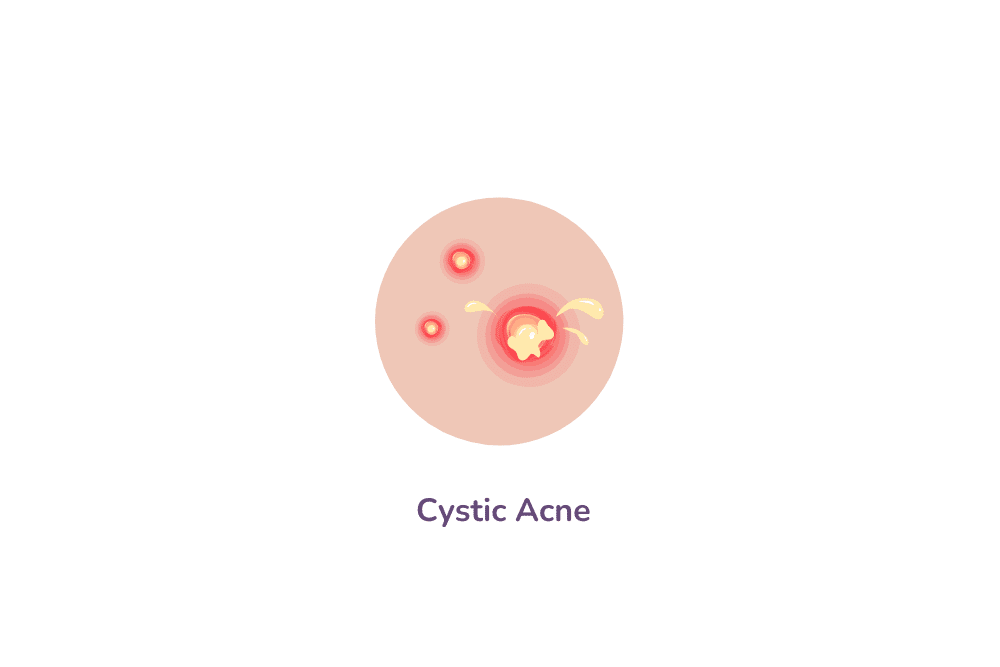 Cystic acne, severe acne