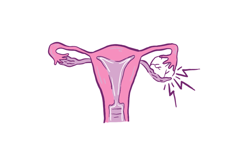 polycystic ovary syndrome, excess hair growth, male hormones