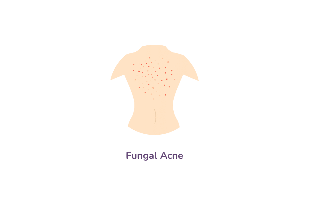 Fungal acne, acne on back