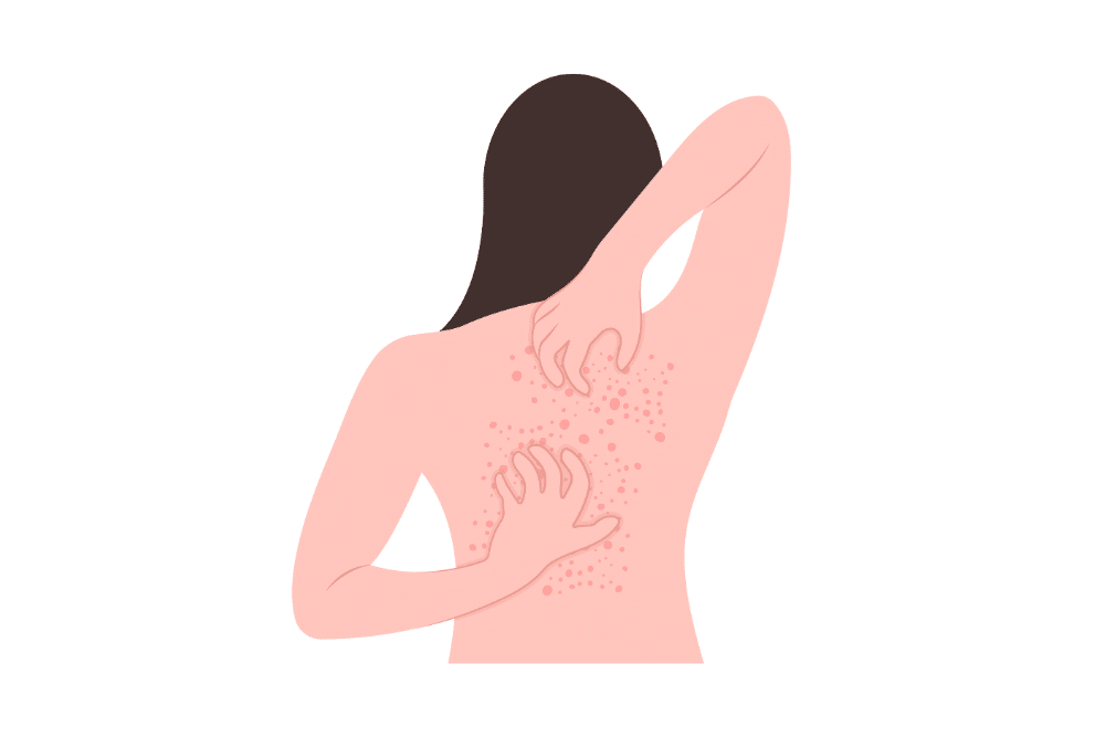 A woman developing fungal acne on the back.