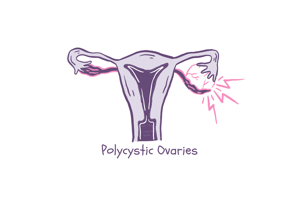 The early signs of PCOS - cysts on ovaries.