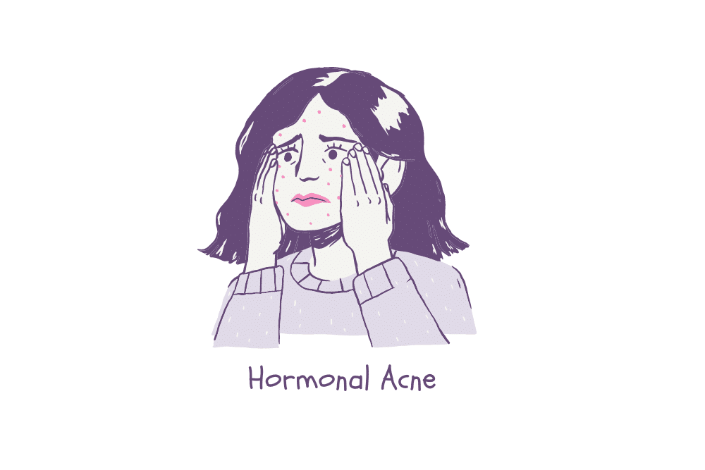 Signs of PCOS - hormonal acne.