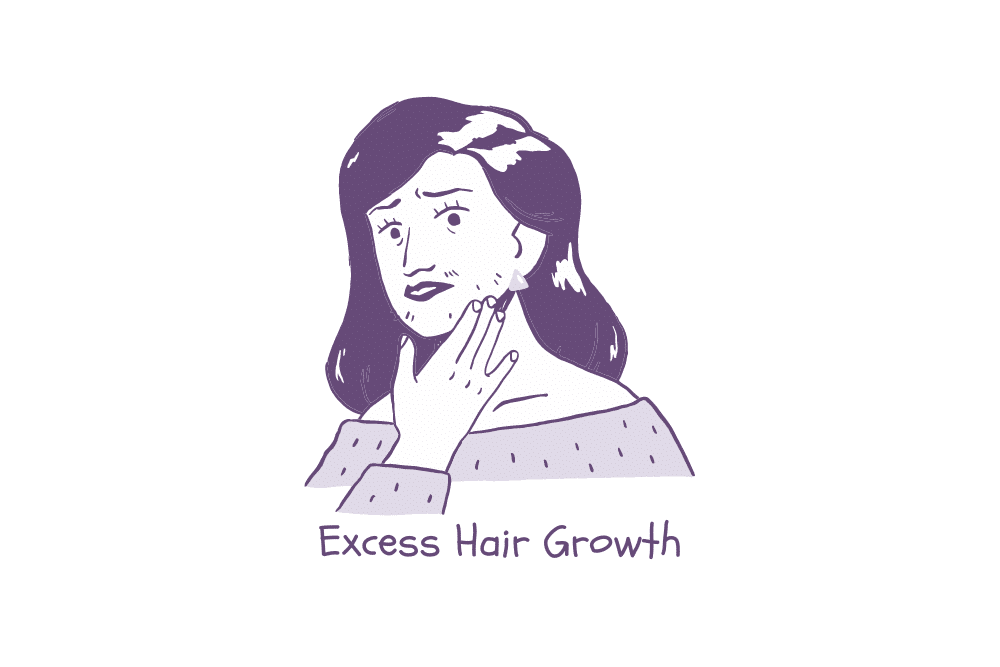 Signs of PCOS - excess hair growth, hirsutism.