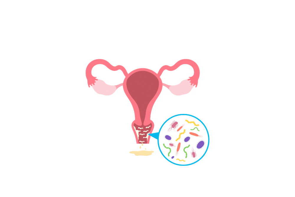 bacterial infection of female reproductive system