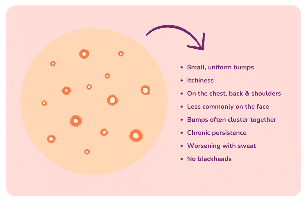 Common symptoms of fungal acne.
