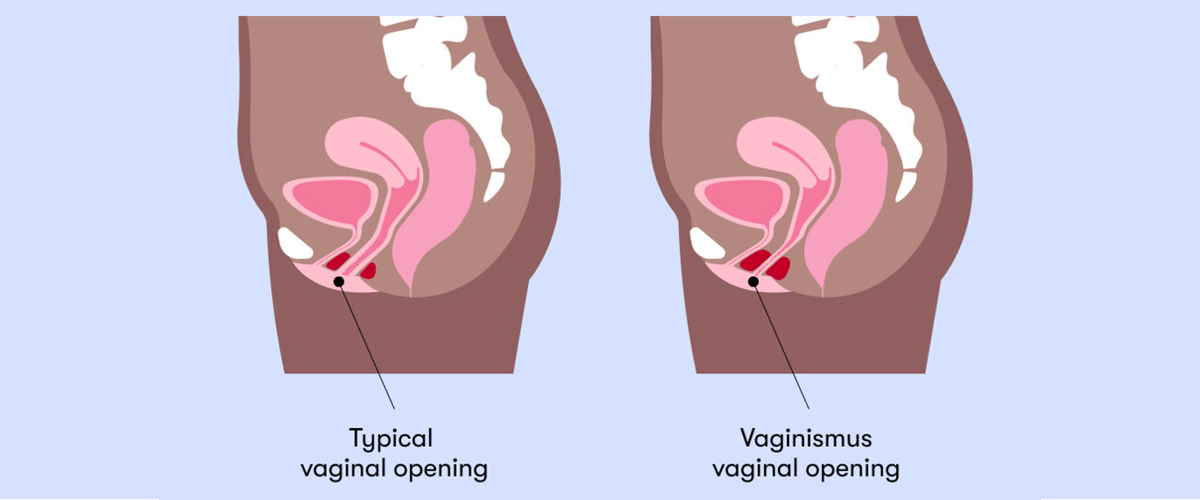 what is Vaginismus?