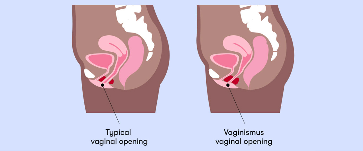 Vaginismus The Sexual Dysfunction Causing Painful Sex for Women